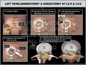 Exhibit of Left Hemilaminectomy & Discectomy at L3-4 & L4-5- Print Quality Instant Download Exhibit of Left Hemilaminectomy & Discectomy at L3-4 & L4-5- Print Quality Instant Download