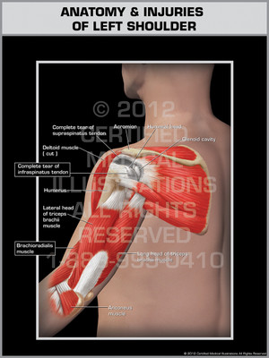 Exhibit of Anatomy & Injuries of Left Shoulder.