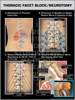 Exhibit of Thoracic Facet Block/Neurotomy Exhibit of Thoracic Facet Block/Neurotomy