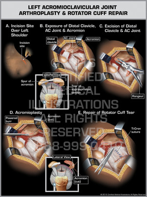 Exhibit of Left Acromioclavicular Joint Arthroplasty & Rotator Cuff Repair.
