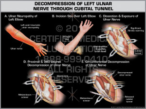 Exhibit of Decompression of Left Ulnar Nerve Through Cubital Tunnel