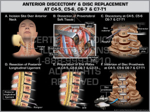 Exhibit of Anterior Discectomy & Disc Replacement at C4-5, C5-6, C6-7 & C7-T1- Print Quality Instant Download Exhibit of Anterior Discectomy & Disc Replacement at C4-5, C5-6, C6-7 & C7-T1- Print Quality Instant Download