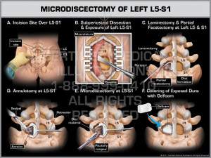 Exhibit of Microdiscectomy of Left L5-S1- Print Quality Instant Download
