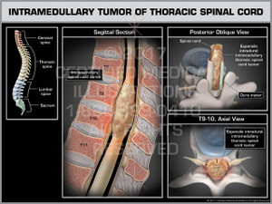 Exhibit of Intramedullary Tumor of Thoracic Spinal Cord- Print Quality Instant Download Exhibit of Intramedullary Tumor of Thoracic Spinal Cord- Print Quality Instant Download