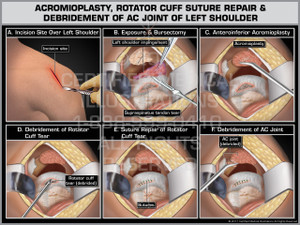 Exhibit of Acromioplasty, Rotator Cuff Suture Repair & Debridement of AC Joint of Left Shoulder Exhibit of Acromioplasty, Rotator Cuff Suture Repair & Debridement of AC Joint of Left Shoulder