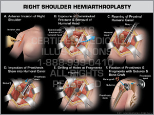 Exhibit of  Right shoulder Hemiarthroplasty