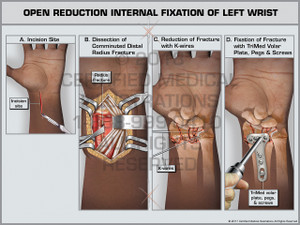 Exhibit of Open Reduction Internal Fixation of Left Wrist
