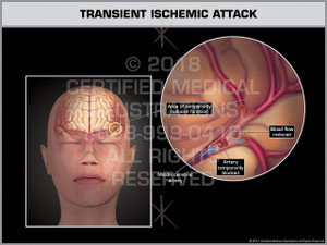 Exhibit of Transient Ischemic Attack- Print Quality Instant Download Exhibit of Transient Ischemic Attack- Print Quality Instant Download