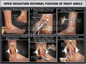Exhibit of Open Reduction Internal Fixation of Right Ankle