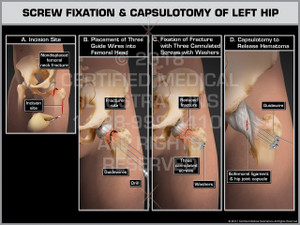 Exhibit of Screw Fixation & Capsulotomy of Left Hip- Print Quality Instant Download Exhibit of Screw Fixation & Capsulotomy of Left Hip- Print Quality Instant Download