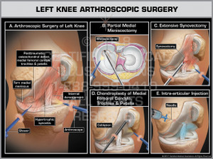 Exhibit of Left Knee Arthroscopic Surgery