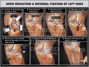 Exhibit of Open Reduction & Internal Fixation of Left Knee- Print Quality Instant Download