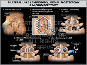 Exhibit of Bilateral L4-L5 Laminotomy, Medial Facetectomy & Microdiscectomy- Print Quality Instant Download
