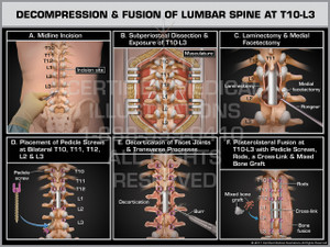 Exhibit of Decompression & Fusion of Lumbar Spine at T10-L3- Print Quality Instant Download Exhibit of Decompression & Fusion of Lumbar Spine at T10-L3- Print Quality Instant Download