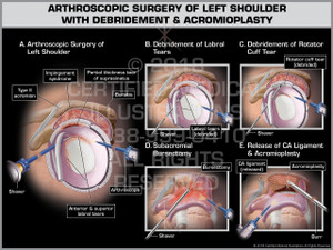Exhibit of Arthroscopic Surgery of Left Shoulder with Debridement & Acromioplasty- Print Quality Instant Download Exhibit of Arthroscopic Surgery of Left Shoulder with Debridement & Acromioplasty- Print Quality Instant Download