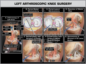 Exhibit of Left Arthroscopic Knee Surgery