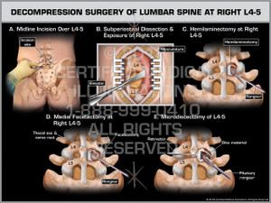 Exhibit of Decompression Surgery of Lumbar Spine at Right L4-5- Print Quality Instant Download Exhibit of Decompression Surgery of Lumbar Spine at Right L4-5- Print Quality Instant Download