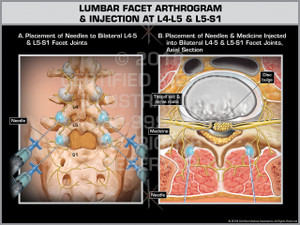 Exhibit of Lumbar Facet Arthrogram & Injection at L4-L5 & L5-S1 Exhibit of Lumbar Facet Arthrogram & Injection at L4-L5 & L5-S1