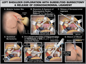 Exhibit of Left Shoulder Exploration with Subdeltoid Bursectomy & Release of Coracoacromial Ligament. Exhibit of Left Shoulder Exploration with Subdeltoid Bursectomy & Release of Coracoacromial Ligament.