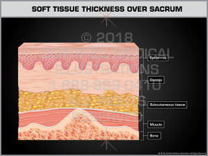 Soft Tissue Thickness over Sacrum Soft Tissue Thickness over Sacrum