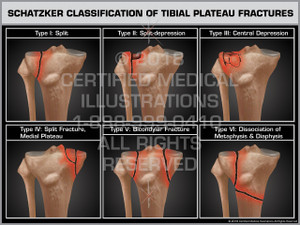 Schatzker Classification of Tibial Plateau Fractures Schatzker Classification of Tibial Plateau Fractures
