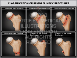 Classification of Femoral Neck Fractures Classification of Femoral Neck Fractures
