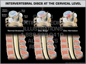 Intervertebral Discs at the Cervical Level