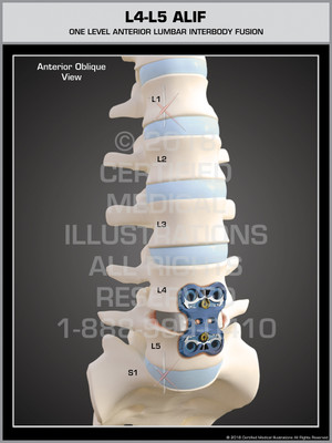 L4-L5 ALIF (Interbody Cage & Plate) L4-L5 ALIF (Interbody Cage & Plate)