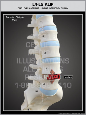L4-L5 ALIF (Anchored Interbody System) L4-L5 ALIF (Anchored Interbody System)