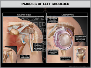 Injuries of Left Shoulder Injuries of Left Shoulder