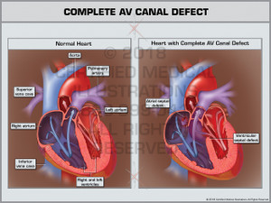 Complete AV Canal Defect Complete AV Canal Defect