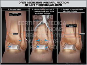Open Reduction Internal Fixation of Left Tibiofibular Joint