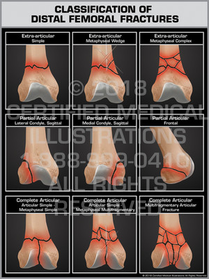 Classification of Distal Femoral Fractures Classification of Distal Femoral Fractures