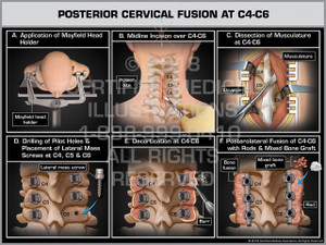 Posterior Cervical Fusion at C4-C6 Posterior Cervical Fusion at C4-C6