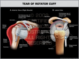 Exhibit of Tear of Rotator Cuff - Right.