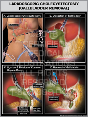 Laparoscopic Cholecystectomy (Gallbladder Removal) without Cystic Duct - Print Quality Instant Download Laparoscopic Cholecystectomy (Gallbladder Removal) without Cystic Duct - Print Quality Instant Download