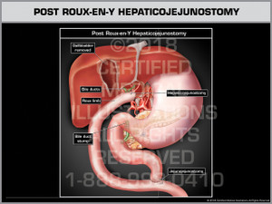 Post Roux-en-Y Hepaticojejunostomy - Print Quality Instant Download Post Roux-en-Y Hepaticojejunostomy - Print Quality Instant Download