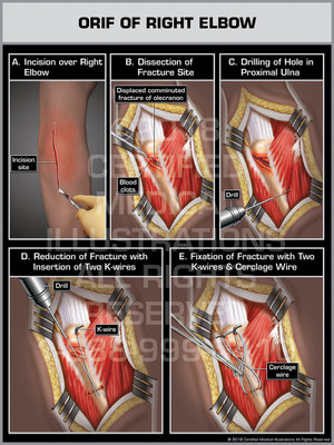 ORIF of Right Elbow
