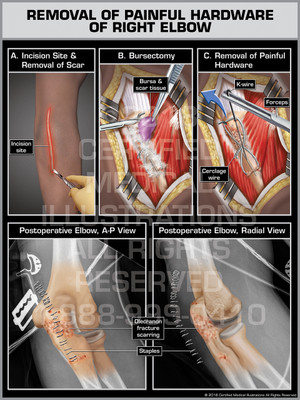 Removal of Painful Hardware of Right Elbow - Print Quality Instant Download