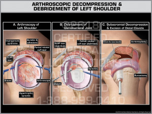 Arthroscopic Decompression & Debridement of Left Shoulder