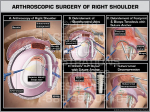 Arthroscopic Surgery of the Right Shoulder - Print Quality Instant Download