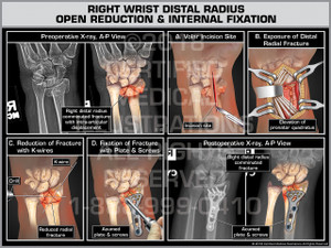 Right Wrist Distal Radius Open Reduction & Internal Fixation - Print Quality Instant Download