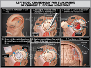 Left-Sided Craniotomy for Evacuation of Chronic Subdural Hematoma Left-Sided Craniotomy for Evacuation of Chronic Subdural Hematoma