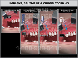 Implant, Abutment & Crown Tooth #3 Implant, Abutment & Crown Tooth #3