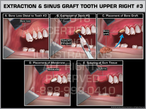 Extraction & Sinus Graft Tooth Upper Right #3 Extraction & Sinus Graft Tooth Upper Right #3
