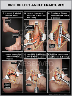 ORIF of Left Ankle Fractures - Print Quality Instant Download ORIF of Left Ankle Fractures - Print Quality Instant Download