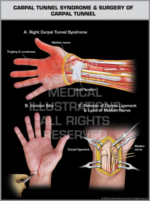 Exhibit of Carpal Tunnel Syndrome & Surgery of Carpal Tunnel - Right Hand.
