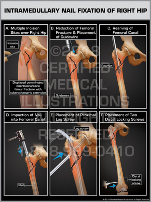 Intramedullary Nail Fixation of Right Hip