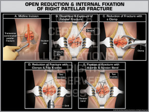 Open Reduction Internal Fixation of Right Patellar Fracture - Print Quality Instant Download