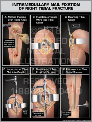 Intramedullary Nail Fixation of Right Tibial Fracture Intramedullary Nail Fixation of Right Tibial Fracture